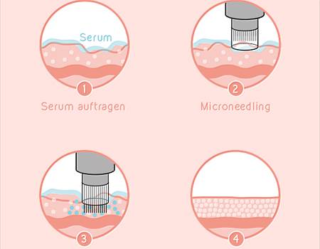 Illustration Microneedeling DE